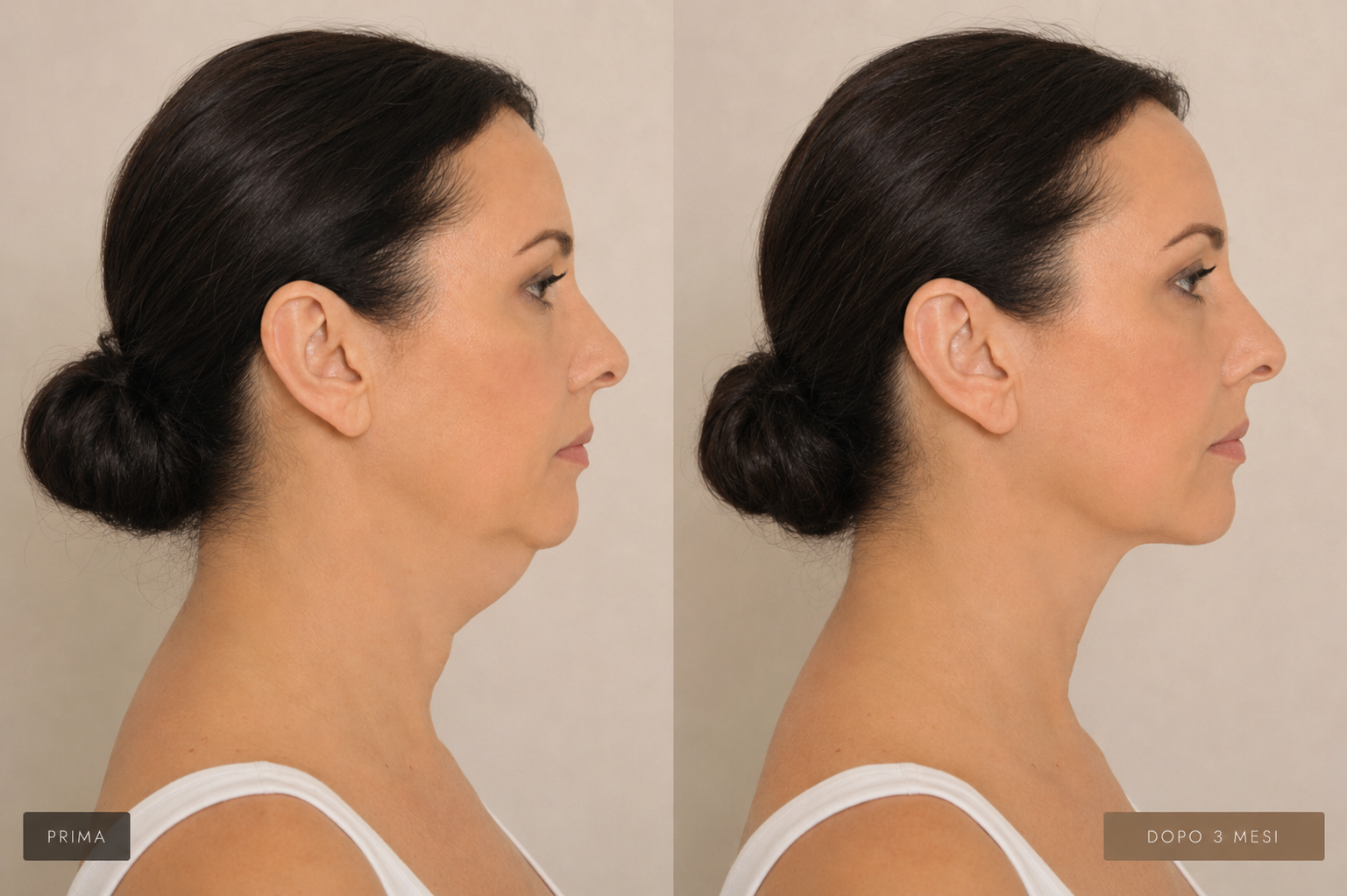 Prima e dopo CHINSCULPT RF